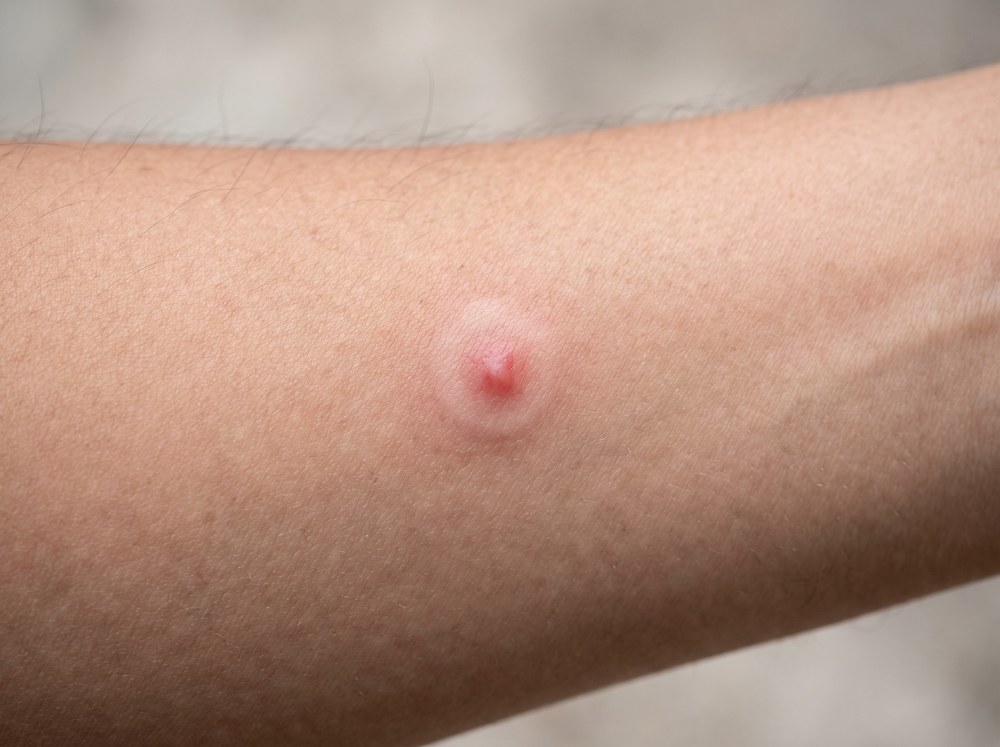 Close-up of a fresh red stable fly bite bump on an ankle with a visible central puncture point and mild swelling